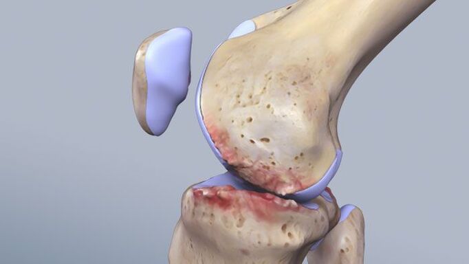 ساختار مفصل زانو تحت تأثیر آسیب شناسی