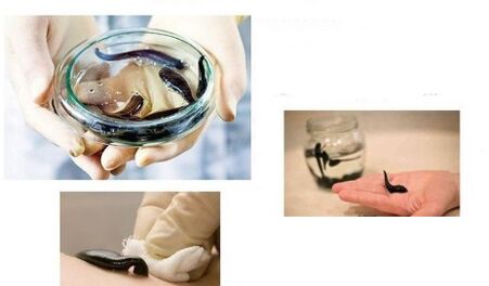 هیرودتراپی برای آرتروز